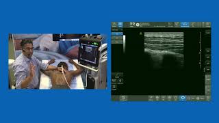 Erector Spine Plane ESP block  Live Demo [upl. by Ennahs]