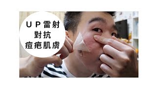 三重知名皮膚科治療！治療痘疤凹洞：UP雷射心得 （上集）  Bolow 菠蘿 [upl. by Coh260]