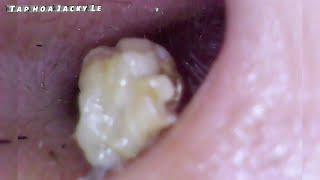 Ear Wax Removal 45 Clean The Inflamed Ear On One Side  Ear Cleaning ASMR [upl. by Arac]