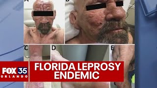 Leprosy endemic in Central Florida CDC warns [upl. by Brennen748]