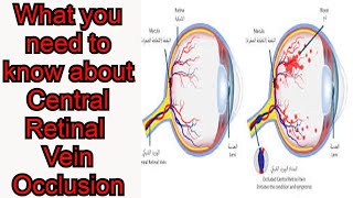 Central Retinal Vein Occlusion CRVO Blurred visionEye pain [upl. by Guy525]