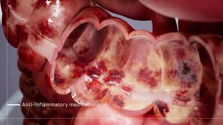 Ulcerative Colitis Medications  3D Medical Animation  Pixeldust Studios [upl. by Panthea]