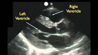 Cardiac Ultrasound  Parasternal Long Axis  Part 1  Sonosite Inc [upl. by Innep708]