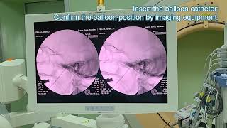 Surgical demonstration of Percutaneous Balloon Compression（PBC）procedure with manometer [upl. by Galan450]