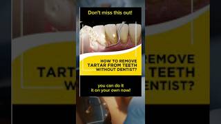 Removing Plaque From Teeth  How To Get Tartar off Teeth at Home tarta teeth dental [upl. by Spark554]