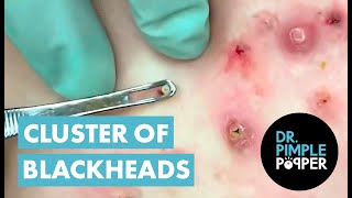 50 Minutes of Blackheads Clusters of Blackheads with Dr Pimple Popper [upl. by Heddy]