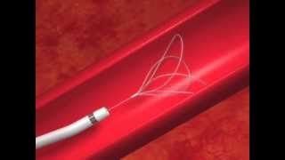 EN Snare® Endovascular Snare amp Catheter Animation [upl. by Nnyrat]