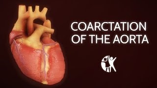 Coarctation of the Aorta [upl. by Ayanal]