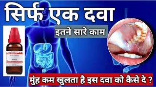 NUXVOMICA। submucous Fibrosis। मुंह के कम खुलने की रामबाण दवा। OSMF medicine। Homiopathy [upl. by Sined223]