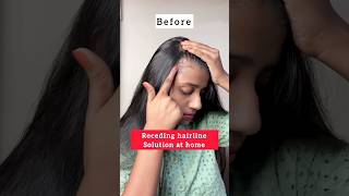 Receding hairline solution at homehair growth tipshairfall haircare hair shorts hairgrowth [upl. by Naga]