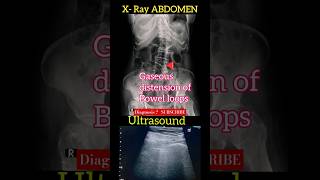 Gaseous distension of bowel loops  X  Ray Abdomen amp USS Abdomen  Diagnosis  Radiology [upl. by Eitsirhc981]