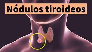 NÓDULOS TIROIDEOS síntomas diagnóstico tratamiento y prevención bulto o bola en el cuello [upl. by Ethelda]