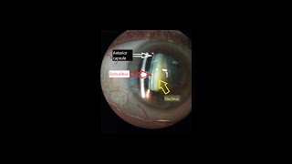 Slit lamp cataract assessment [upl. by Yekcin725]