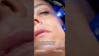 Microneedling microneedling trattamentiviso [upl. by Schreibman]