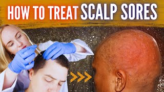 How To Treat Scalp Sores [upl. by Natsreik]