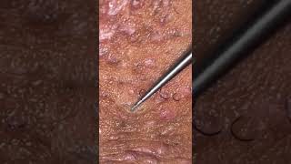 Ingrown Hair Removal Ep15 [upl. by Bill136]