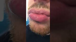 1 month on Flexitol Lip Balm to treat dry peeling lips exfoliative cheilitis [upl. by Wales262]