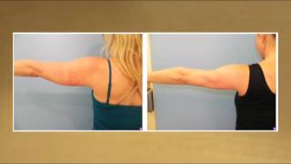 Laser Lipo for Slimmer Arms  Testimonial [upl. by Adnilrev]