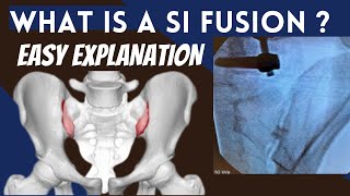 SI Joint Fusion Explanation of how it can stop back pain permanently [upl. by Davin]