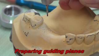 1 Rest Seat Preparation  for partial denture Construction [upl. by Neelyt]