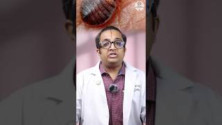 Bed Bugs ayurvedaindia doctor indianayurvedicdoctor ayurvediclife [upl. by Rabi]