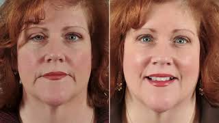 Blepharoplasty Indications and Basic concepts [upl. by Desiree]