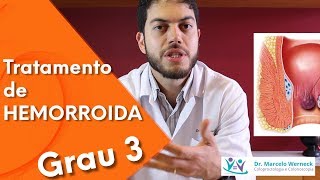 Como é o tratamento de HEMORROIDA grau 3  Dr Marcelo Werneck [upl. by Shermy]