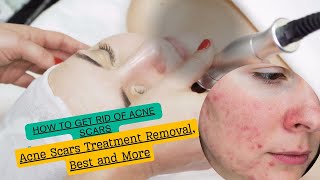 Acne Scars Treatment Removal Best and More [upl. by Sailesh299]