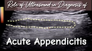 Ultrasound Acute Appendicitis  How to Prevent from False ve Diagnosis in Initial Stage [upl. by Rochemont]