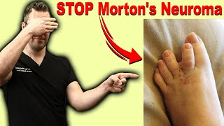 CURE Mortons Neuroma Metatarsalgia amp Ball of the Foot Pain FAST [upl. by Piegari]