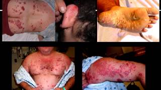 Stelara Side Effects  Stelara causes drug induced psoriasis  Biologic problems [upl. by Finzer7]