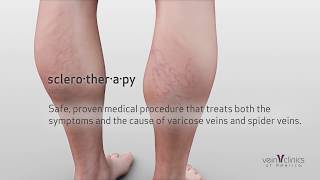 What is sclerotherapy treatment  Vein Clinics of America [upl. by Annoyt758]