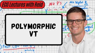 Polymorphic Ventricular Tachycardia  Day 23 ECG Challenge [upl. by Malissia]