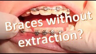 Nonextraction Orthodontics 2x4 Dgainer Mechanics [upl. by Audra332]