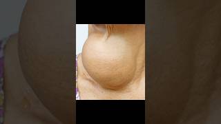 Goiter Huge Thyroid Growth in Someone’s Neck [upl. by Atsyrhc]