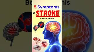 5 Symptoms of Stroke Beware of this [upl. by Akemrehs]