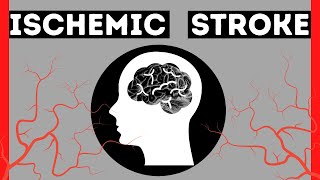 What is an ISCHEMIC STROKE  SignsSymptoms  EMBOLIC vs THROMBOTIC STROKE  Stroke Awareness [upl. by Ahsilyt]