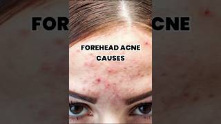 Forehead Acne Causes  skin care tips shorts [upl. by Etnuahs]