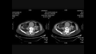 Aneurisma Aorta Abdominal  abdominal aortic aneurysm physical examination [upl. by Elawalo]