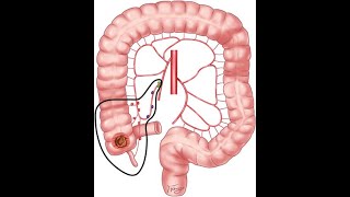 TOTAL LAPAROSCOPIC HEMICOLECTOMY WITH STAPLED ANASTMOSIS [upl. by Nohsauq85]