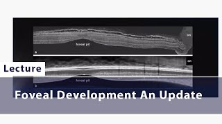 Foveal Development An Update [upl. by Ahsyek]