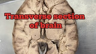 transverse section of brain  corpus callosum  lentiform nucleus Nepaliviral foryou [upl. by Katha]