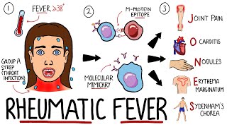 Rheumatic Fever Made Easy Including Jones Criteria and Mnemonic [upl. by Alfy]