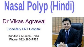 Nasal Polyps in Hindi by Dr Vikas Agrawal [upl. by Red]