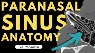 Paranasal Sinuses and Nasal Cavity  Radiology anatomy part 1 prep  CT imaging [upl. by Ahsyt]