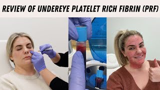 Undereye Platelet Rich Fibrin PRF Review [upl. by Sylvie]