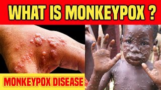 What is Monkeypox virus  What does Monkeypox look like [upl. by Florri799]