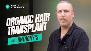 Anthonys Experience I Organic Hair Transplant I Estetik International [upl. by Spalla]