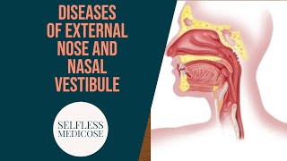 DIEASES OF EXTERNAL NOSE and NASAL VESTIBULE with important questions part 1 [upl. by Clemente]