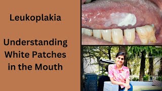 Leukoplakia Understanding White Patches in the Mouth [upl. by Felicidad]